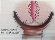 宮頸癌篩查沒那么簡(jiǎn)單，這些技巧助你提高取樣質(zhì)量
